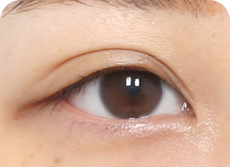 이전 수술 시 라인이 너무 높게 디자인 됐을 경우