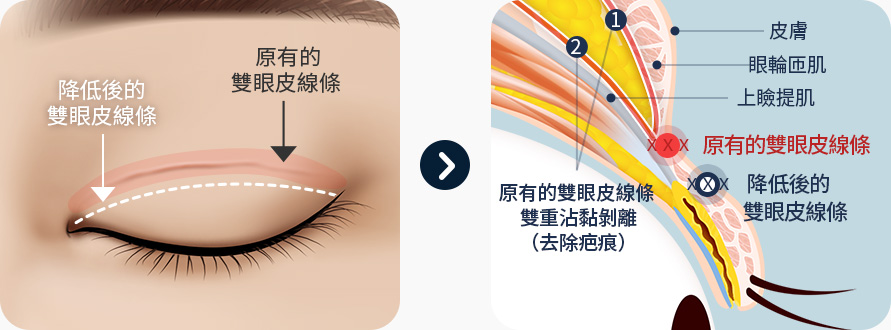 원더풀 라인낮추기 기존 쌍꺼풀 라인 2중 유착 박리 흉터제거