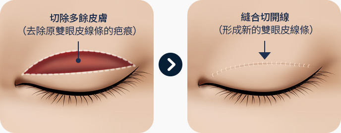 피부 연부조직 절제 피부 여유가 있는 경우