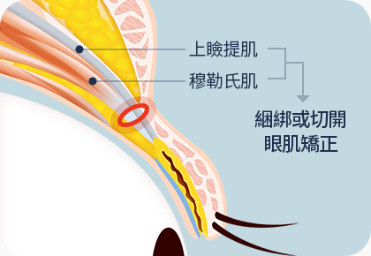 원더풀 라인낮추기 상안검거근 뮬러근 눈매교정