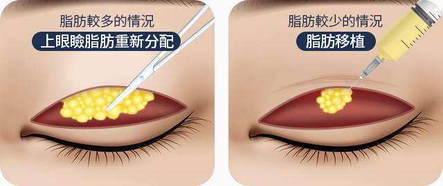 눈꺼풀 지방이 적은 경우 눈위지방재배치 지방이 적은 경우 지방이식