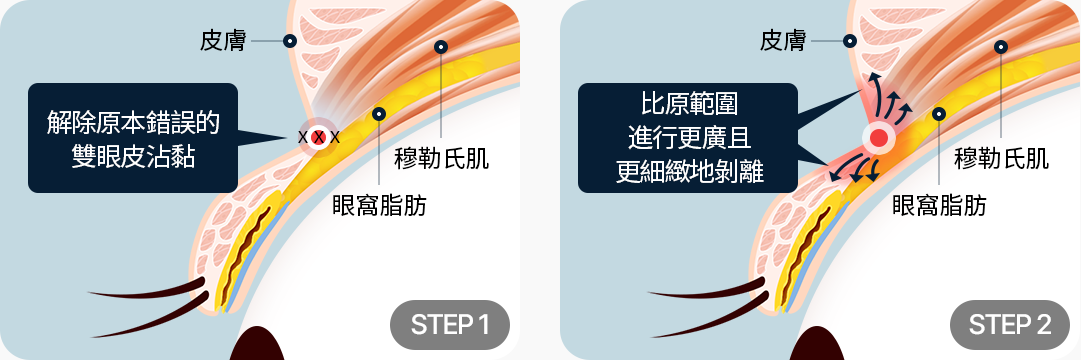 조직손상 최소화 기존 잘못된 쌍꺼풀 유착풁기 기존 범위보다 넓고 섬세하게 박리