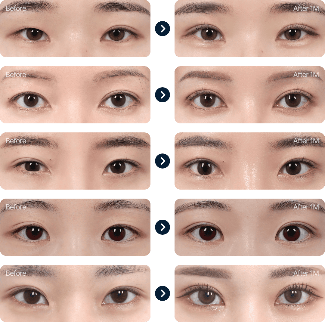 눈재수술 전후사진