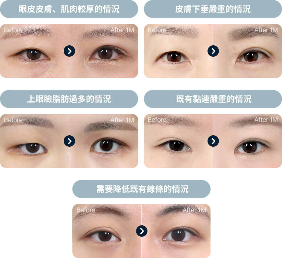 원더풀 완전절개 피부 근육이 두꺼운 경우 피부 처짐 눈위 지방이 많은경우 기존 유착이 심한경우 기존 라인을 낮추는 경우