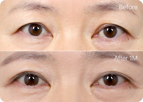 원더풀 완전절개 완전절개 피부절제 눈매교정