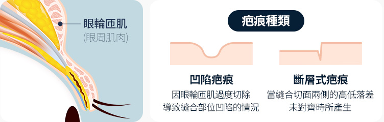 원더풀 라인낮추기 두줄따기 노하우 숙련된 의료진 고난이도 재수술 눈재수술