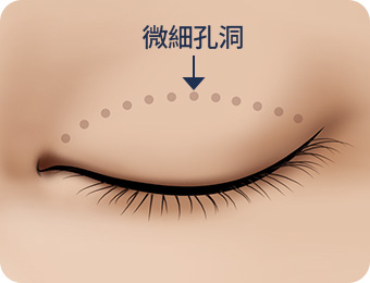 원더풀 자연유착 미세홈