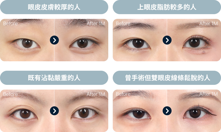 Wonderful 部分切開 피부 근육이 두꺼운 경우 피부 처짐 눈위 지방이 많은경우 기존 유착이 심한경우 기존 라인을 낮추는 경우