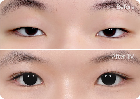 Wonderful 部分切開 지방제거 윗트임