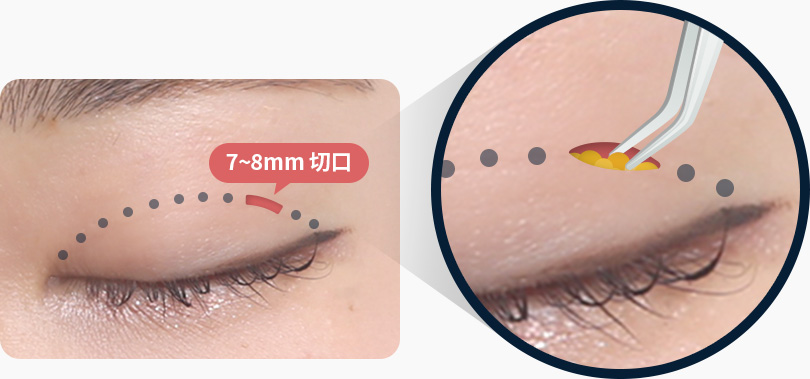 원더풀 라인낮추기 두줄따기 노하우 숙련된 의료진 고난이도 재수술 눈재수술