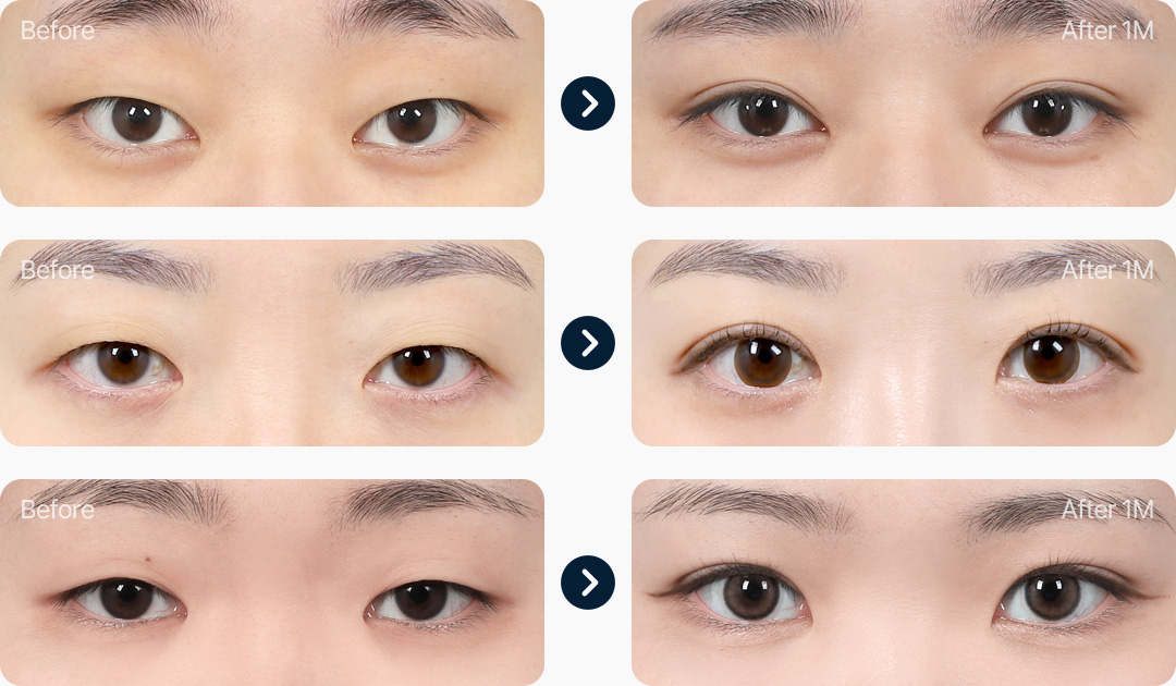 부분절개 전후사진