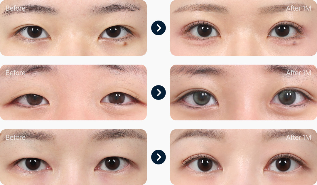 부분절개 전후사진