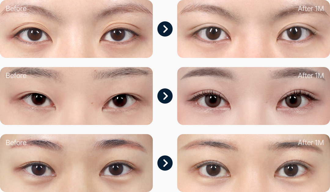 부분절개 전후사진