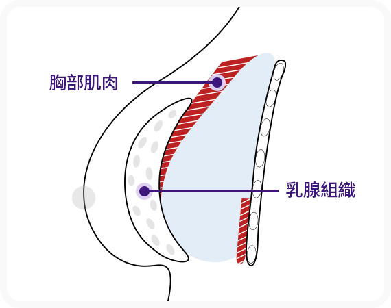 근막하 보형물 삽입 가슴근육막 가슴근육 사이
