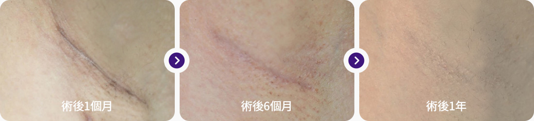 겨드랑이 절개 후기 1개월차 6개월차 1년차