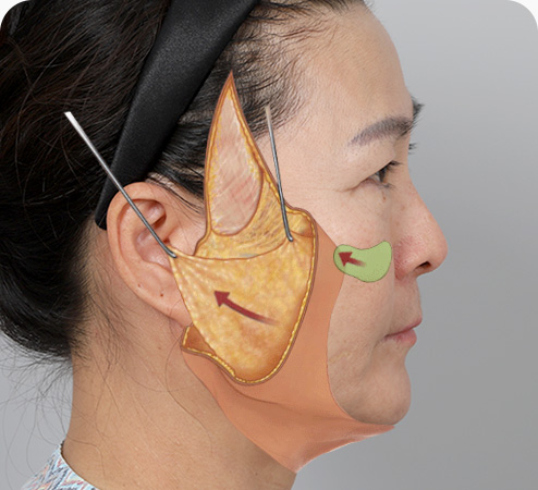 안면거상 수술방법 늘어진 근막층 피부 지방 근육 당겨 고정