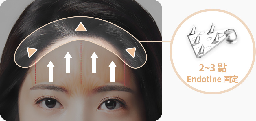 이마거상 정품 엔도타인 2개 3개 포인트 엔도타인고정