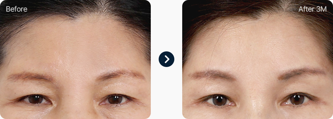 이마거상 전후사진 이마거상후기