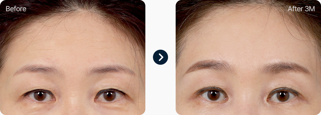 이마거상 전후사진 이마거상후기