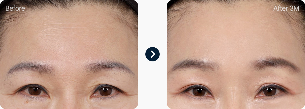 이마거상 전후사진 이마거상후기