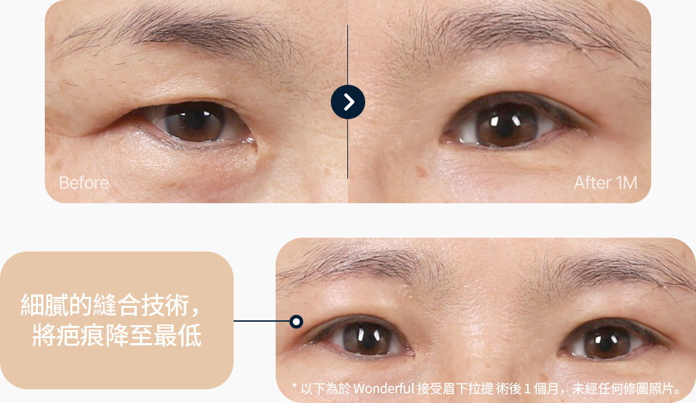 눈썹하거상술 전후사진 눈썹하거상술후기 섬세한 봉합기술 흉터최소화