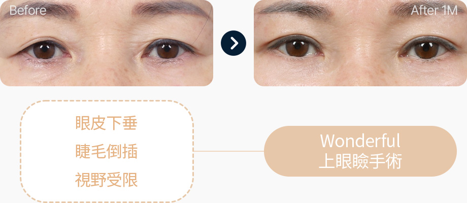 상안검 전후사진 중년상안검 상안검후기 눈꺼풀처짐 속눈썹이 눈을 찌름 시야확보 어려움