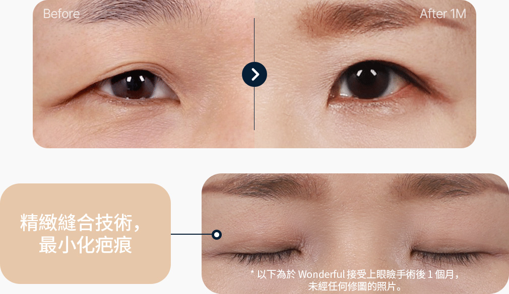 상안검 전후사진 중년상안검 상안검후기 섬세한 봉합기술로 흉터 최소화