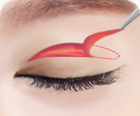 상안검 수술방법 늘어진 눈꺼풀 피부 지방 제거