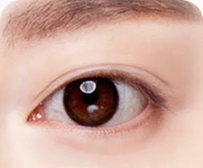 상안검 수술방법 또렷하고 매끈한 눈매완성