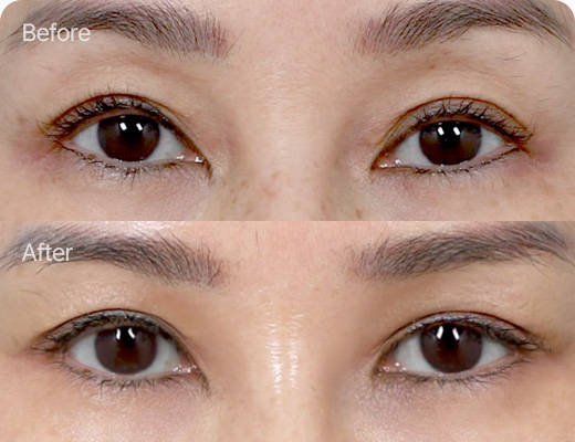 상안검 전후사진 상안검 후기