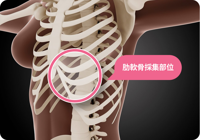 늑연골 채취 부위 갈비뼈 아래위치