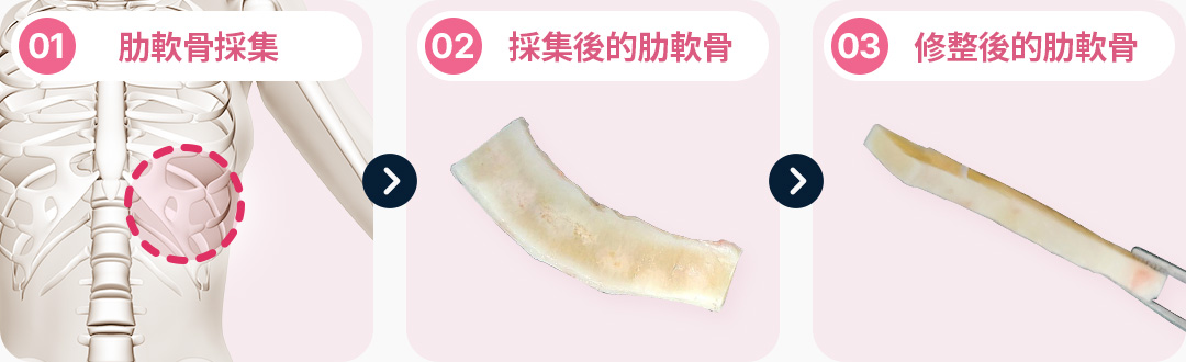 늑연골 채취 채취한 늑연골 다듬은 늑연골