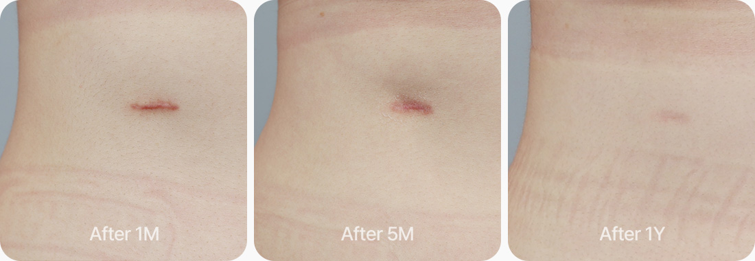 늑연골 채취 흉터 최소화 1개월후 5개월후 1년후