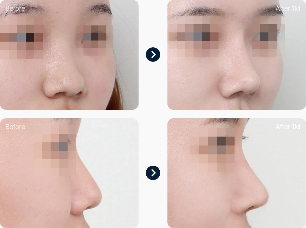 복코 교정 자가늑연골+귀연골 전후사진