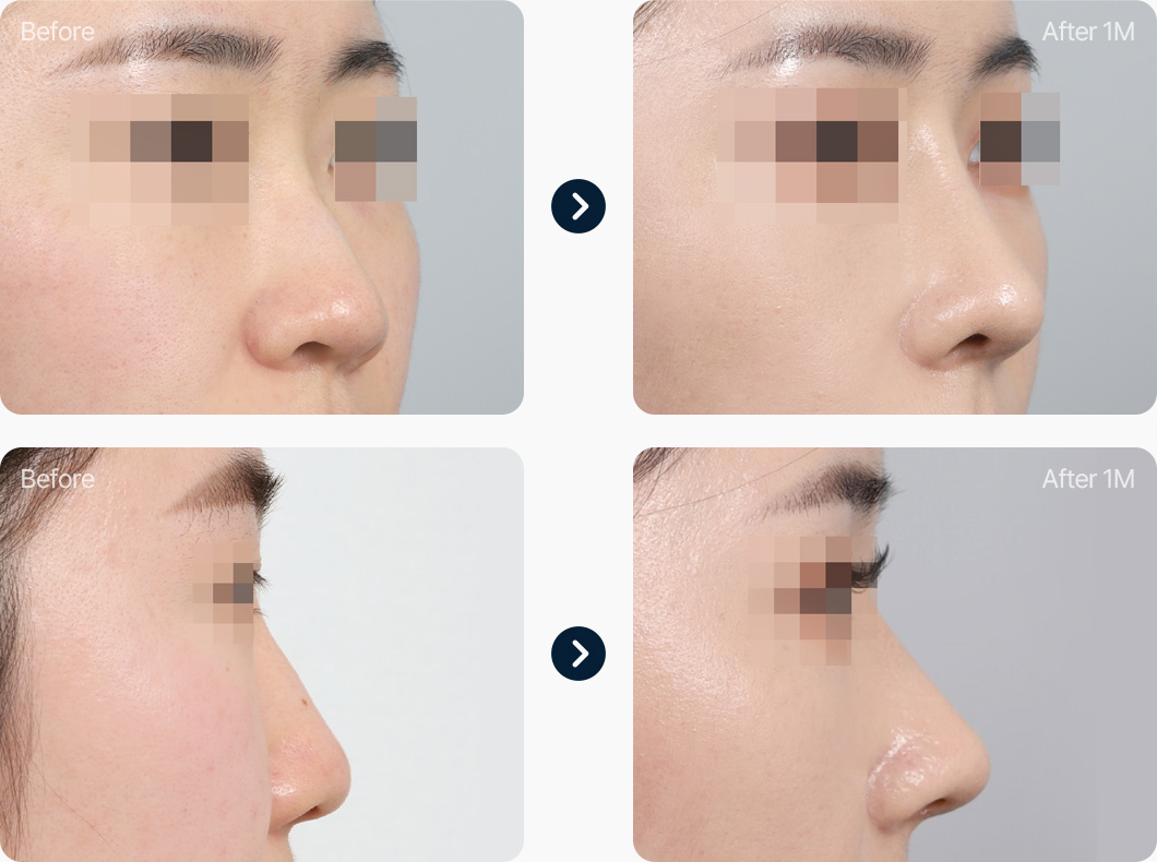 기본코성형 자가늑연골 전후사진