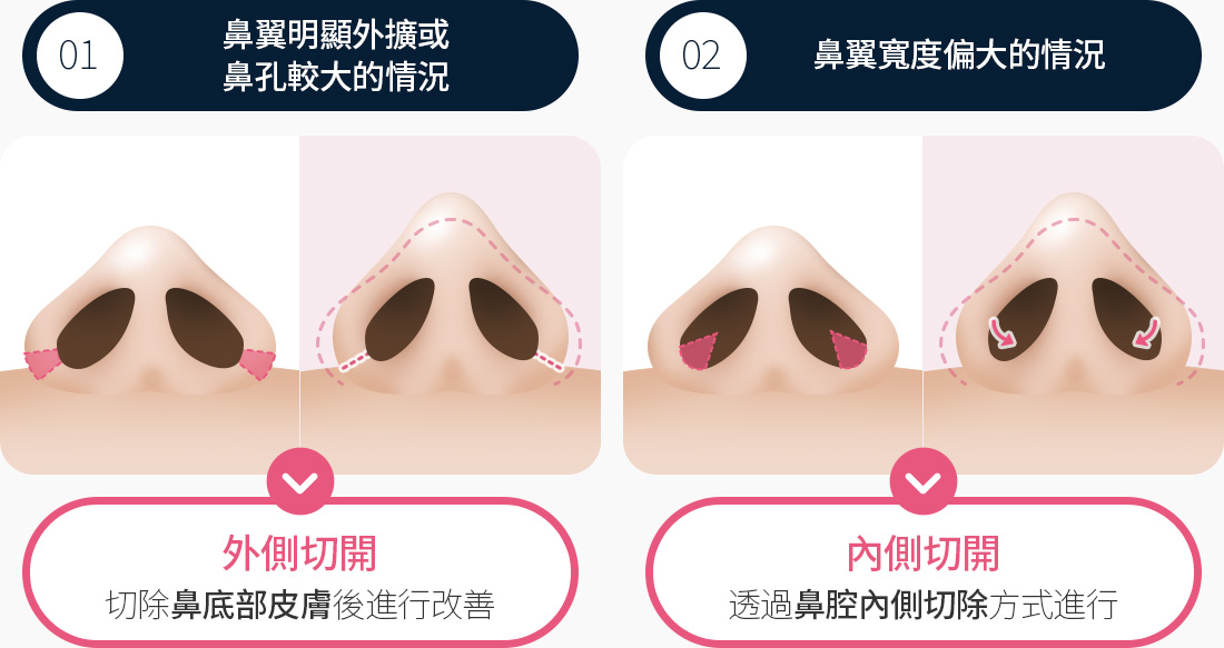 심하게 퍼진 콧날개 큰 콧구멍 외측절개 코 바닥 피부 절제 폭 넓은 콧날개 내측 절개 코 안쪽 절제