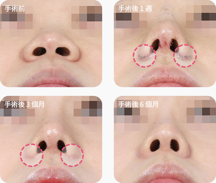 콧볼축소 흉터 경과 수술 1주차 3개월차 6개월차