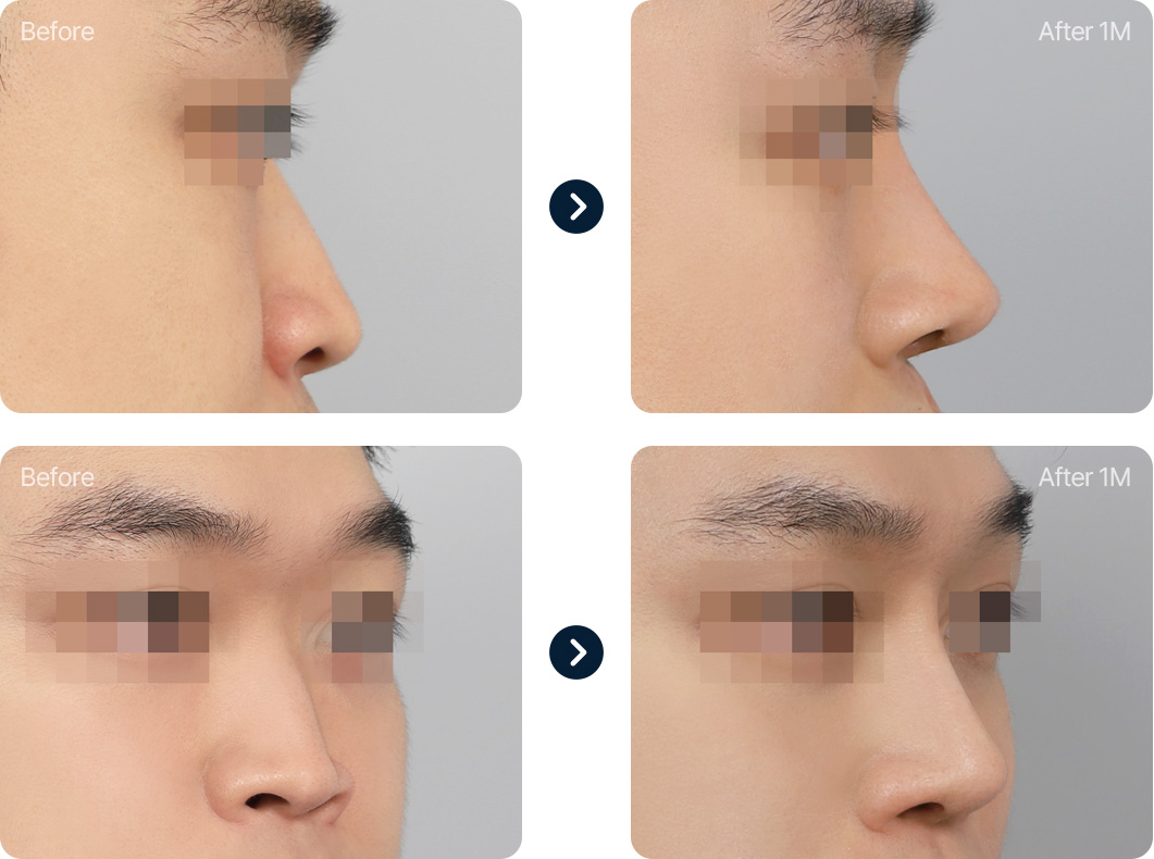 낮은코 성형 전후사진