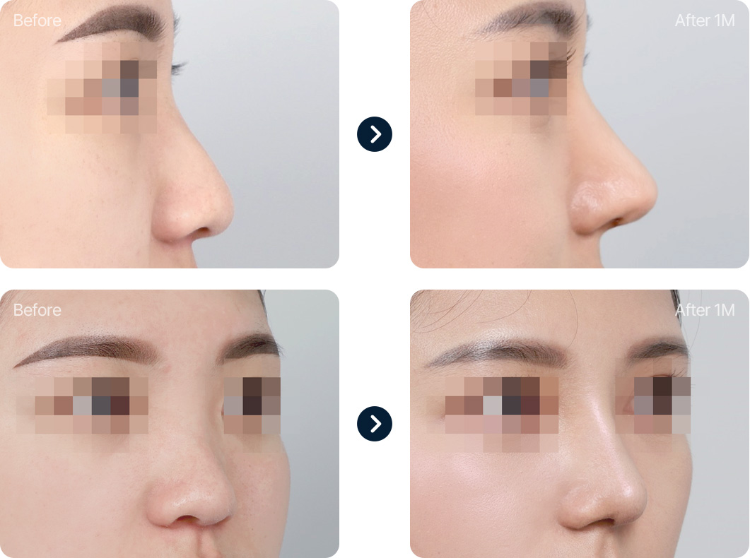 낮은코 성형 전후사진