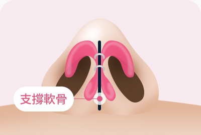 복코 성형 지지연골