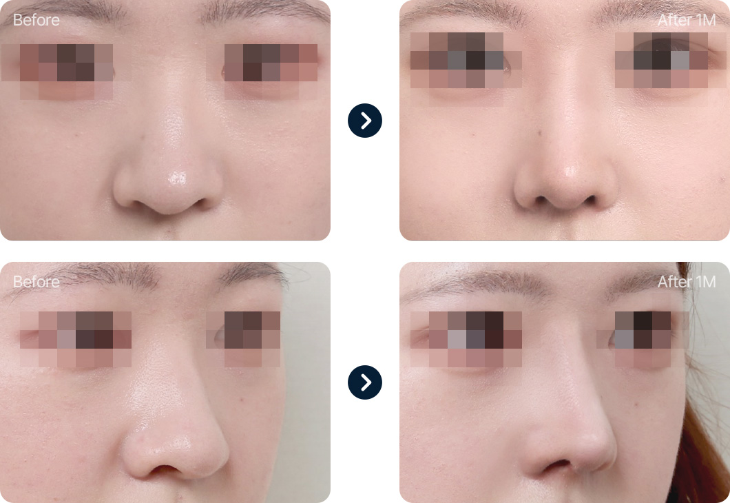 복코 성형 전후사진