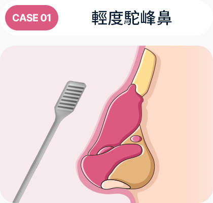 심하지 않은 매부리코