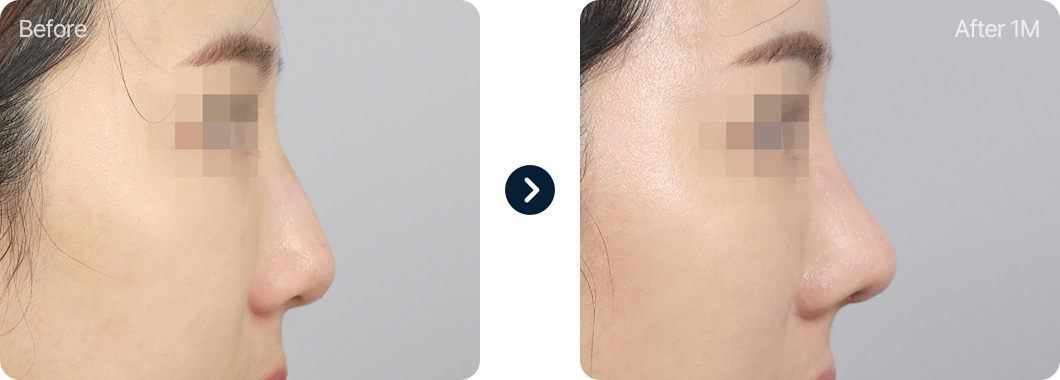 매부리코 성형 전후사진