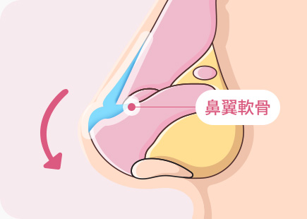 짧은코 들창코 수술 날개연골