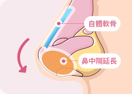 짧은코 들창코 수술 자가연골 비중격 연장