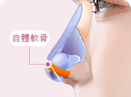 화살코 긴코 수술방법 자가연골