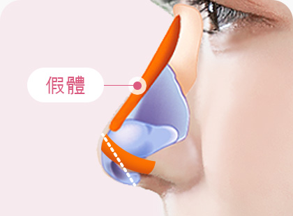 화살코 긴코 수술방법 보형물