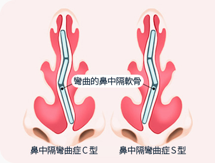 휘어진 비중격 연골 비중격 만곡증 C형 S형