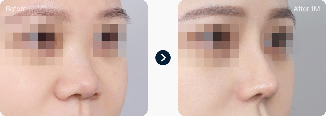 복코 코성형 전후사진