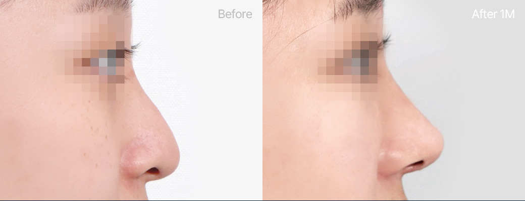 화살코 + 매부리코성형 기증늑연골 전후사진